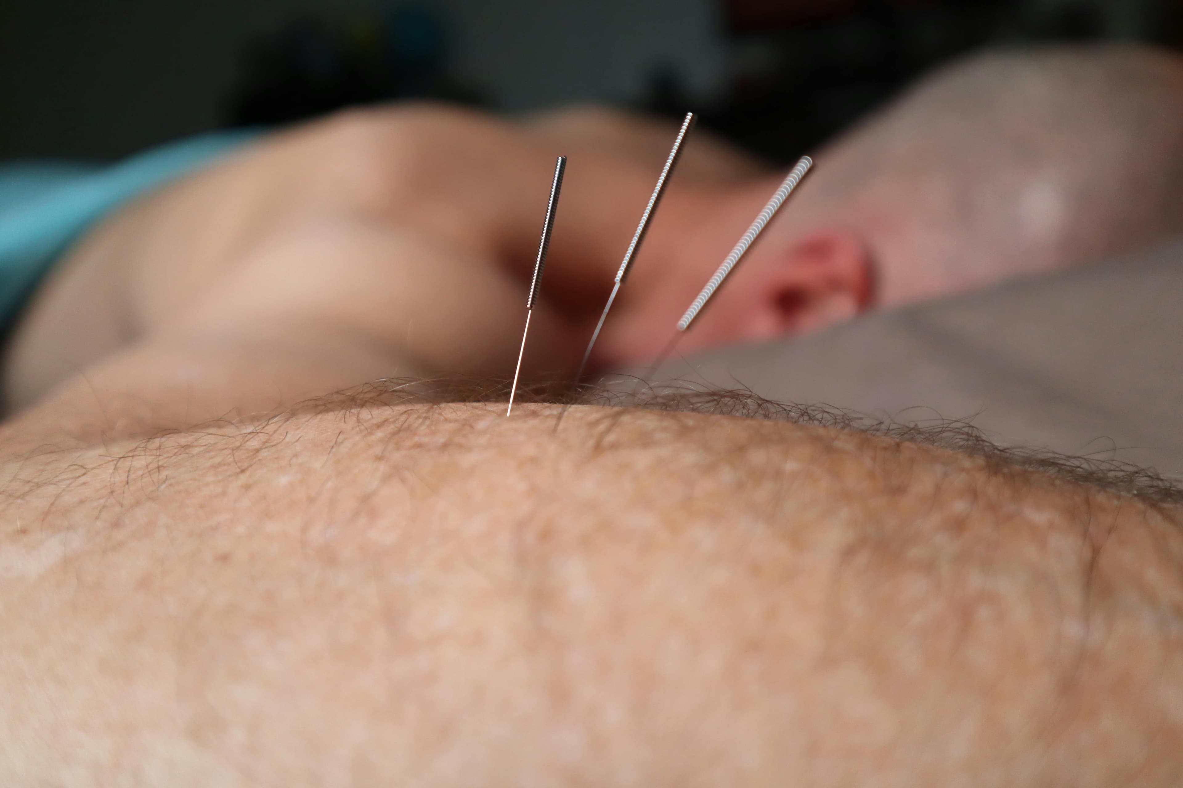 Dry Needling